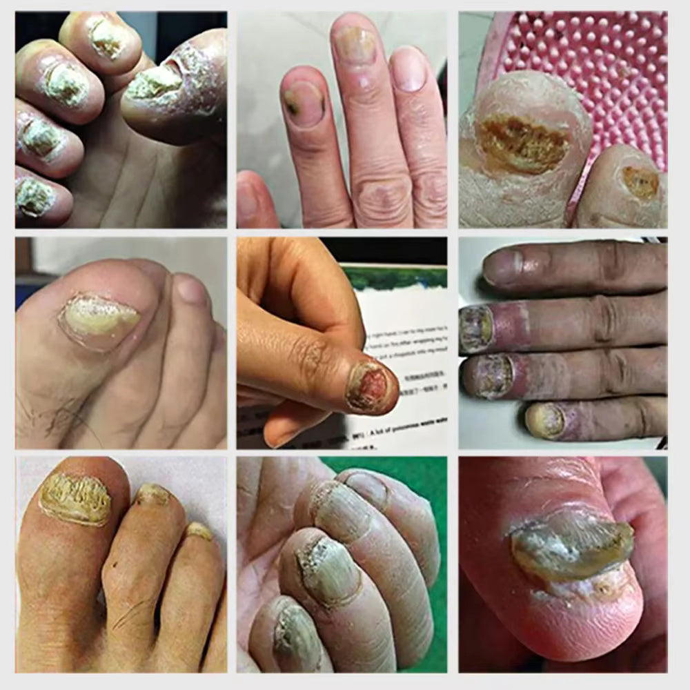 Borelis Fongile Nail Repairer