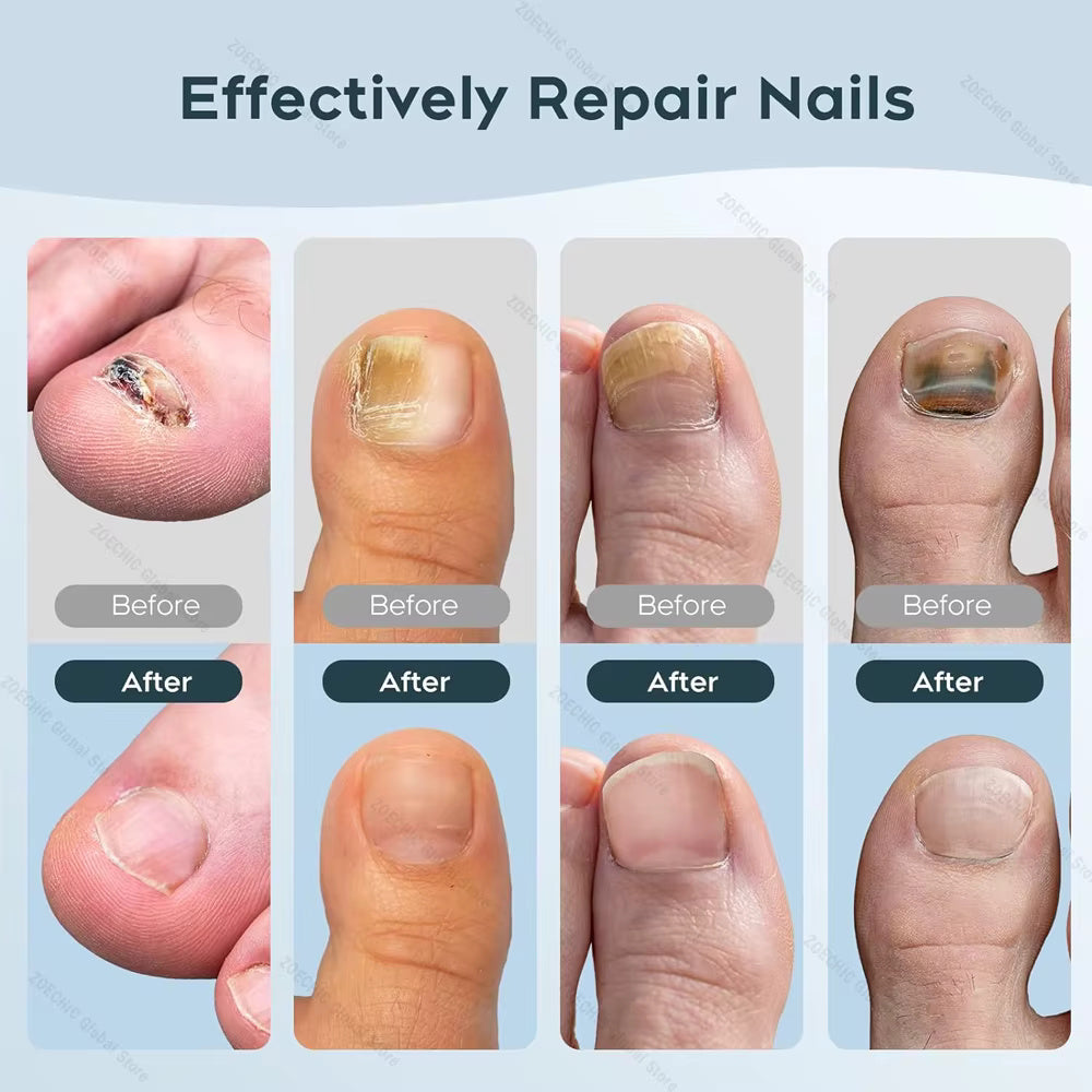 Borelis Fongile Réparateur d'ongles