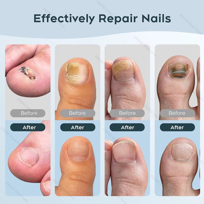 Borelis Fongile Nail Repairer